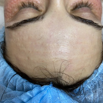 Корекція заломів