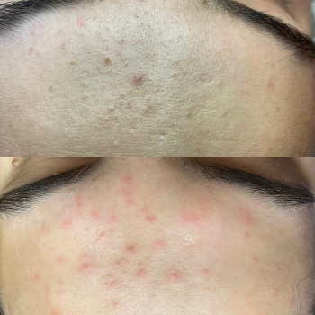 Чистка/пілінги