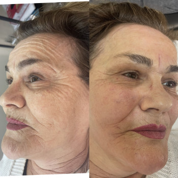 Біоревіталізація
                    Косметолог Лілія Ровно