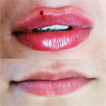 Збільшення губ
                    Косметолог-инъекционист Татьяна Ирпень