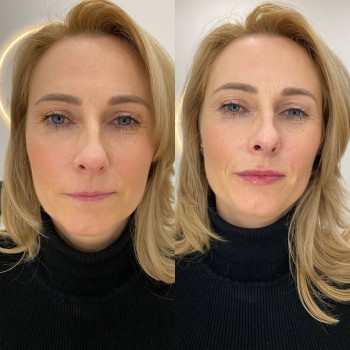 Збільшення губ
                    Косметолог-инъекционист Татьяна Ирпень