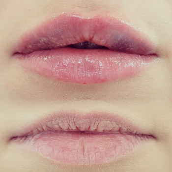 Збільшення губ
                    Косметолог-инъекционист Татьяна Ирпень