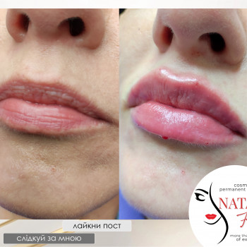 Аугментація губ (збільшення губ) від косметолога Наталії Філь

   