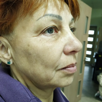 РФ ліфтинг.обличчя до процедури.