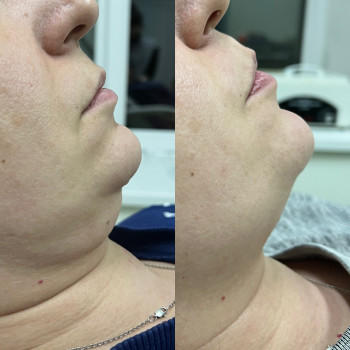 Робота ліполітиками.
Безпечні і результативні препарати