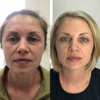 Ботулінотерапія з урахуванням біомеханіки
                    Косметолог Маргарита Дніпро