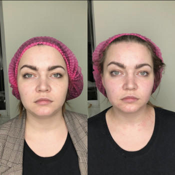 Ботулінотерапія з урахуванням біомеханіки
                    Косметолог Маргарита Дніпро