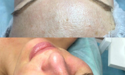 Очищення обличчя Лікар-косметолог Ксенія Кам'янець-Подільський