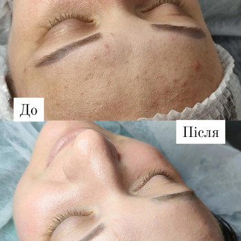 Очищення обличчя
                    Врач-косметолог Ксенія Каменец-Подольский