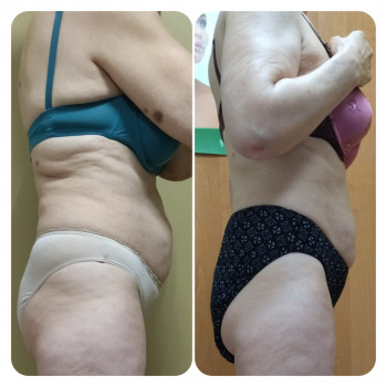 Антицеллюлитный массаж