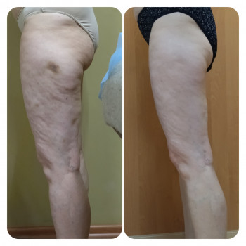 Антицеллюлитный массаж