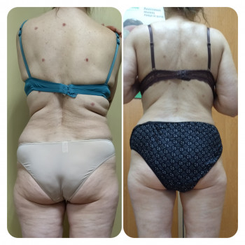 Антицеллюлитный массаж