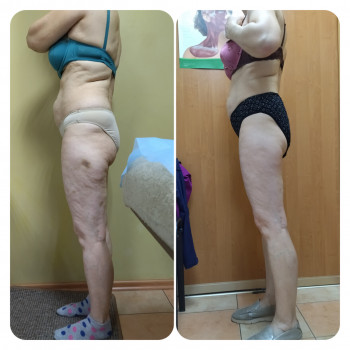 Антицеллюлитный массаж