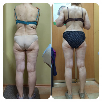 Антицеллюлитный массаж