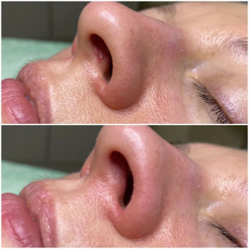 Видалення судин.