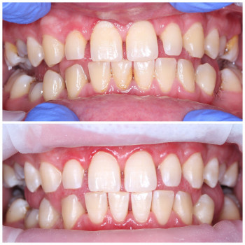 Лікування пародонтиту
Пародонтит 1-4 ст
Здоров'я ясен
Комплексне лікування ясен
Терапія пародонтиту
Глибоке очищення зубів
Лікування ясен
Профілактика пародонтиту
Стоматологічне лікування
Відновлення ясен