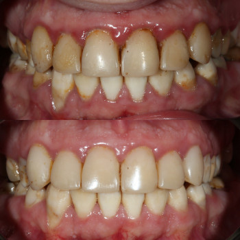 Лікування ясен
Профілактика пародонтиту
Стоматологічне лікування
Відновлення ясен
Сучасні методи лікування
Стоматологія ясен