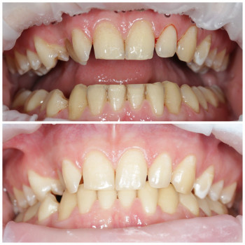 Лікування ясен
Профілактика пародонтиту
Стоматологічне лікування
Відновлення ясен
Сучасні методи лік...