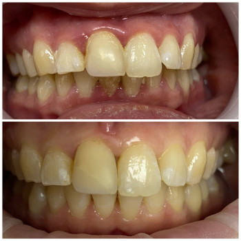 Лікування ясен
Профілактика пародонтиту
Стоматологічне лікування
Відновлення ясен
Сучасні методи лік...