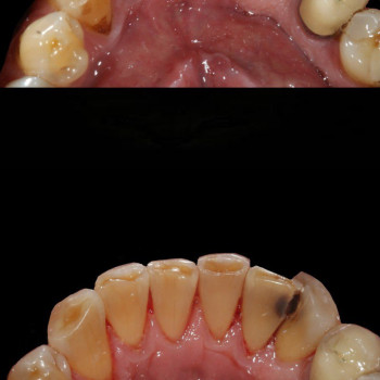 Лікування ясен
Профілактика пародонтиту
Стоматологічне лікування
Відновлення ясен
Сучасні методи лік...