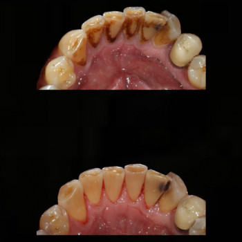 Лікування ясен
Профілактика пародонтиту
Стоматологічне лікування
Відновлення ясен
Сучасні методи лік...