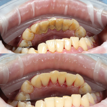 стоматолог пародонтолог Лікування ясен
Профілактика пародонтиту
Стоматологічне лікування
Відновлення...