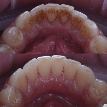 Лікування ясен
Профілактика пародонтиту
Стоматологічне лікування
Відновлення ясен
Сучасні методи лік...