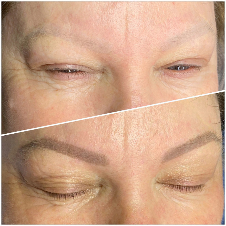 Видалення татуажу ремувером,результат трьох процедур, фото - Майстер перманентного макіяжу Ольга Лопатньова