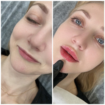 Філлер Juvederm