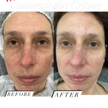 Проміжний результат , 4 процедури PRX -T33