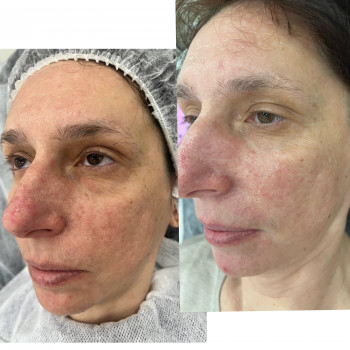 Освітлення , омолодження та покращення якості шкіри