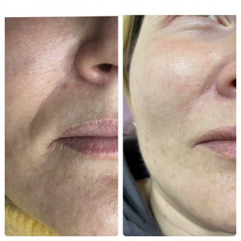 Контурна пластика носогубної зморшки. Після цієї процедури м