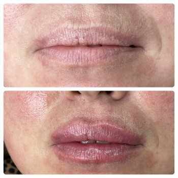 У моєї клієнтки, головний запит був, зробити губи більш прив