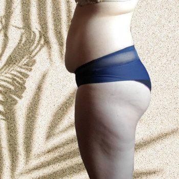 До процедури (кавітація+вакуум)