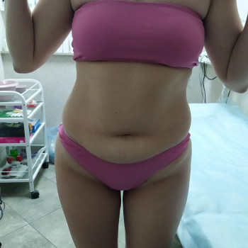 Фото після кількох процедур