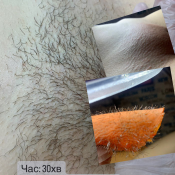 Первинна депіляція