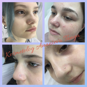 Пирсинг крыла носа   
 