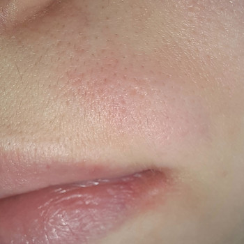 Електро Епіляція
                    Електролог Наталя Хмельницький