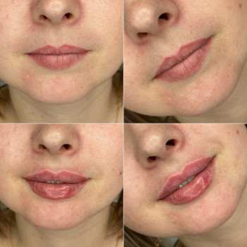 Контурная пластика лица
                    Косметолог-инъекционист Алина Днепр