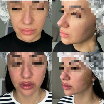 Контурная пластика лица
                    Косметолог-инъекционист Алина Днепр