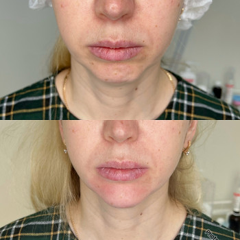 Контурная пластика лица
                    Косметолог-инъекционист Алина Днепр