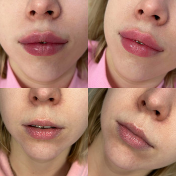 Контурная пластика лица
                    Косметолог-инъекционист Алина Днепр