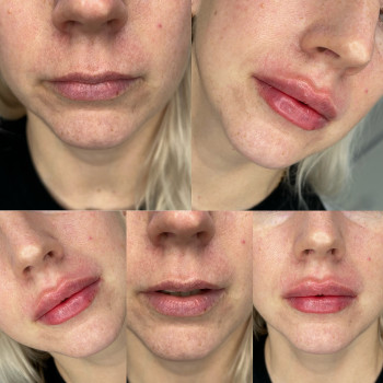 Контурная пластика лица
                    Косметолог-инъекционист Алина Днепр