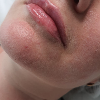 Збільшення губ.