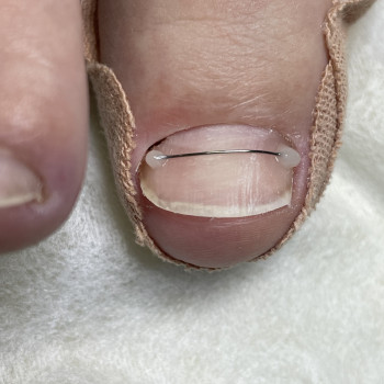 Титанова нитка