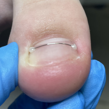 Подологічний педикюр
                    Подолог Наталія Київ