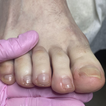 Оніхолізис