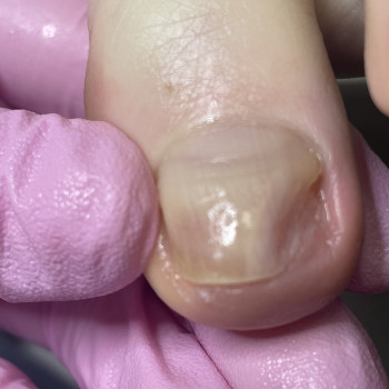 Оніхолізис