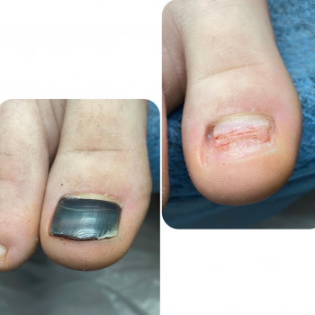 Зачистка травмованої нігтьової пластини