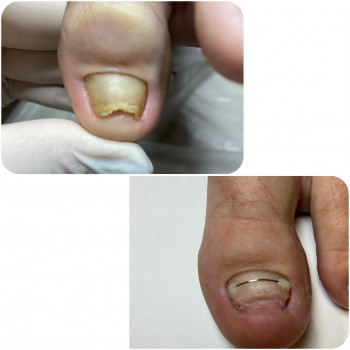 Встановлення корекційної системи «Титанова нитка»